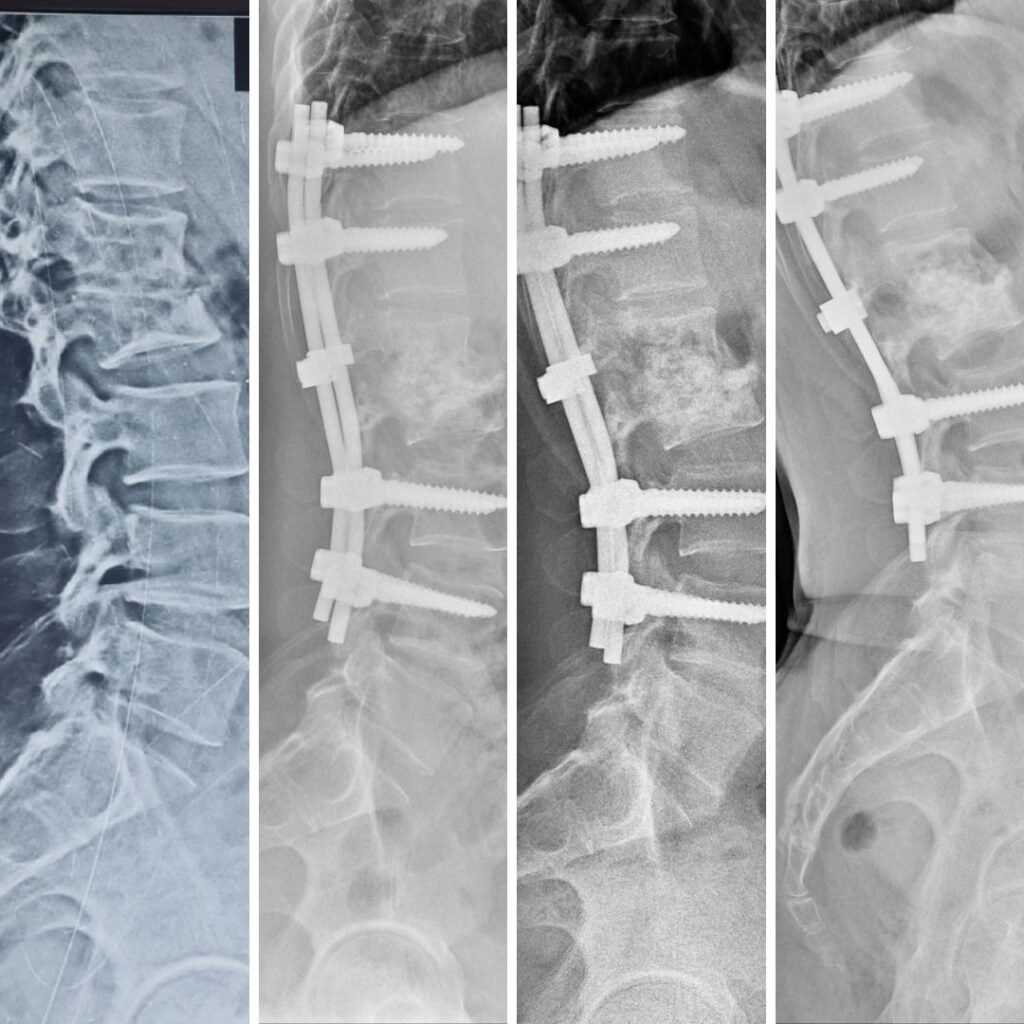 Thoracic Spine Recovery