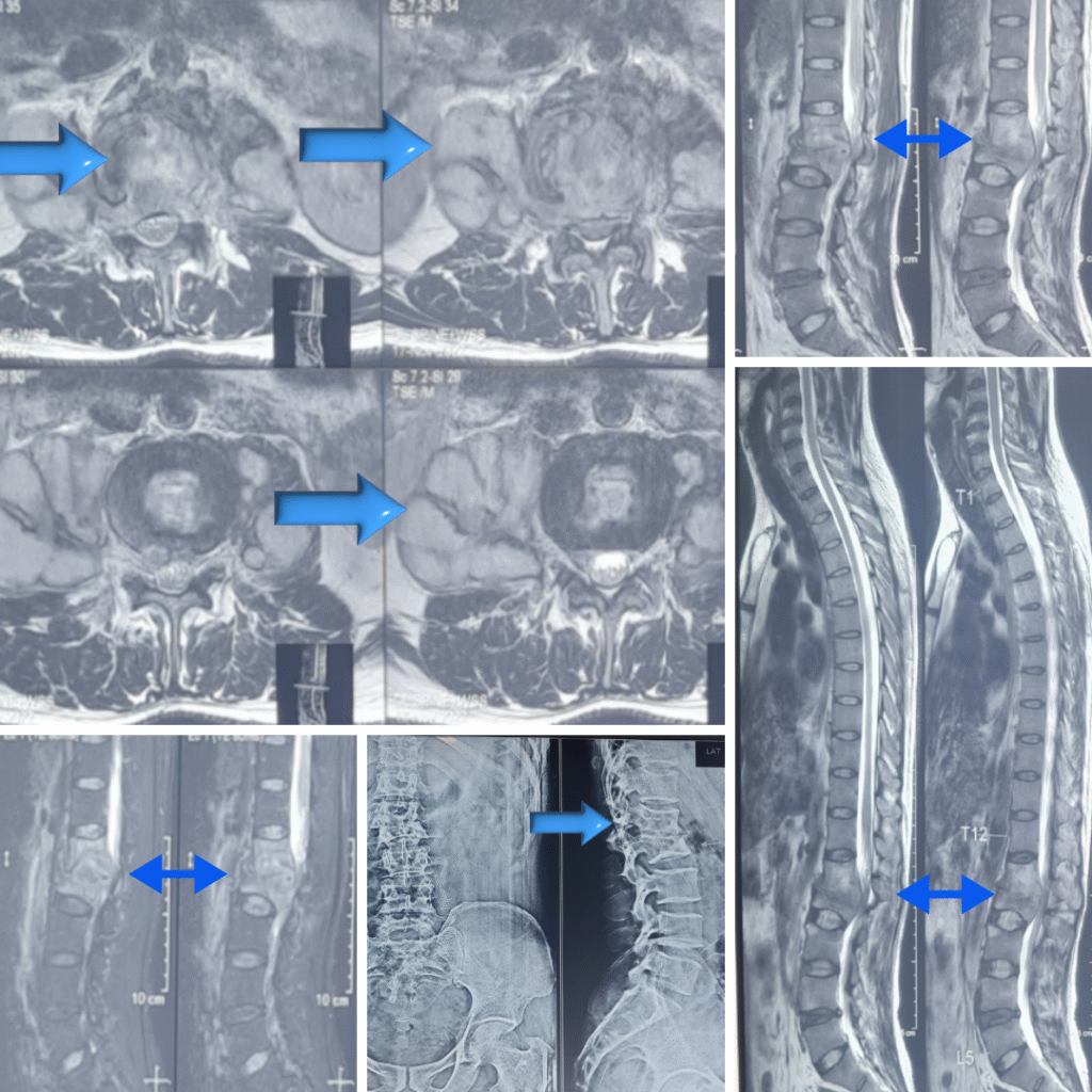 Thoracic Spine Recovery
