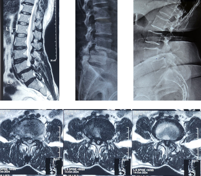 Lumbar Spinal Treatment