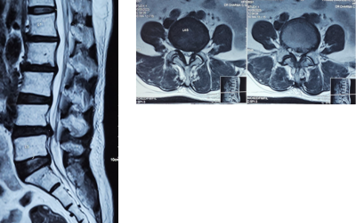 slip disc treatment and lower back recovery