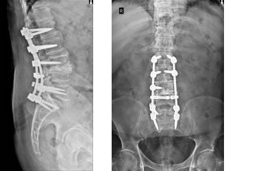 Spinal infection treatment