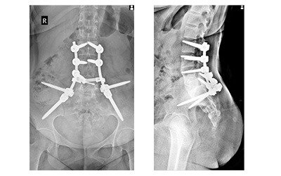Lumbar Spine Infection Treatment