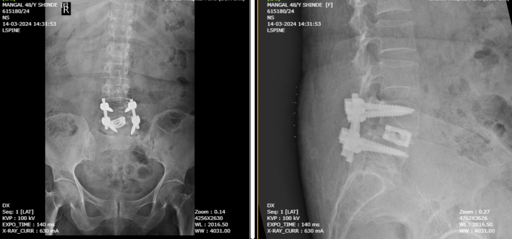 Slip Disc and Lumbar Spine