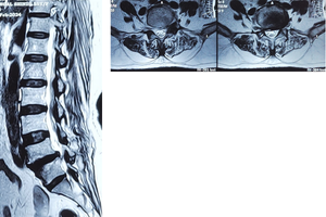 Slip Disc and Lumbar Spine