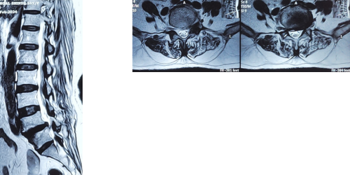 Slip Disc and Lumbar Spine