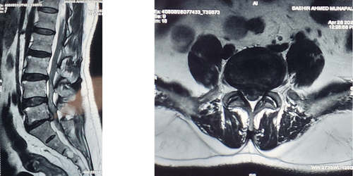 Slip Disc Treatment