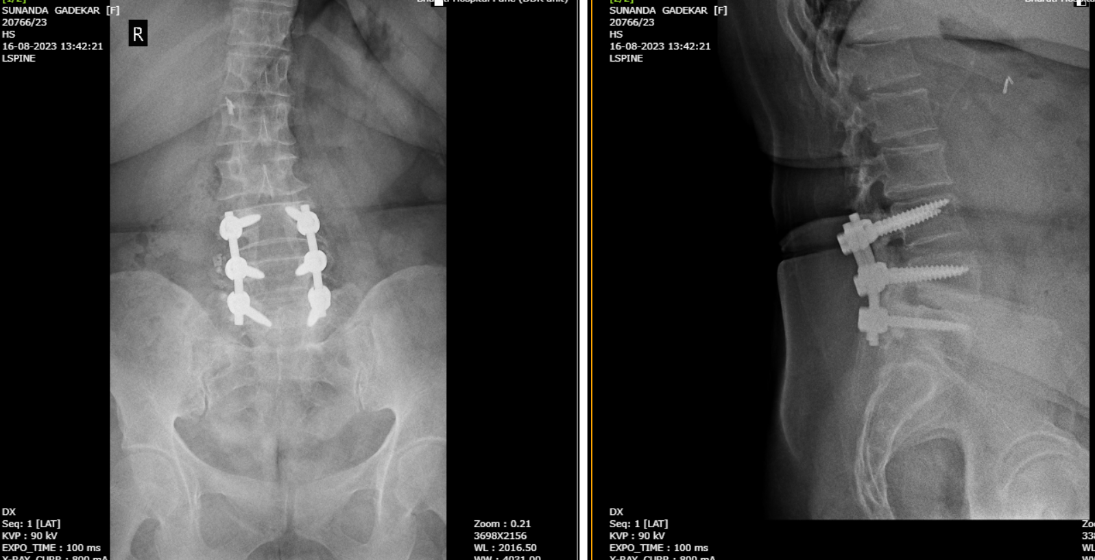 Back pain treatment