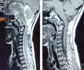 Best Cervical Treatment in Pune