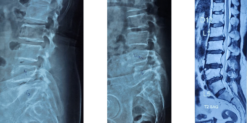Spinal surgery
