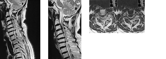 Neck pain treatment